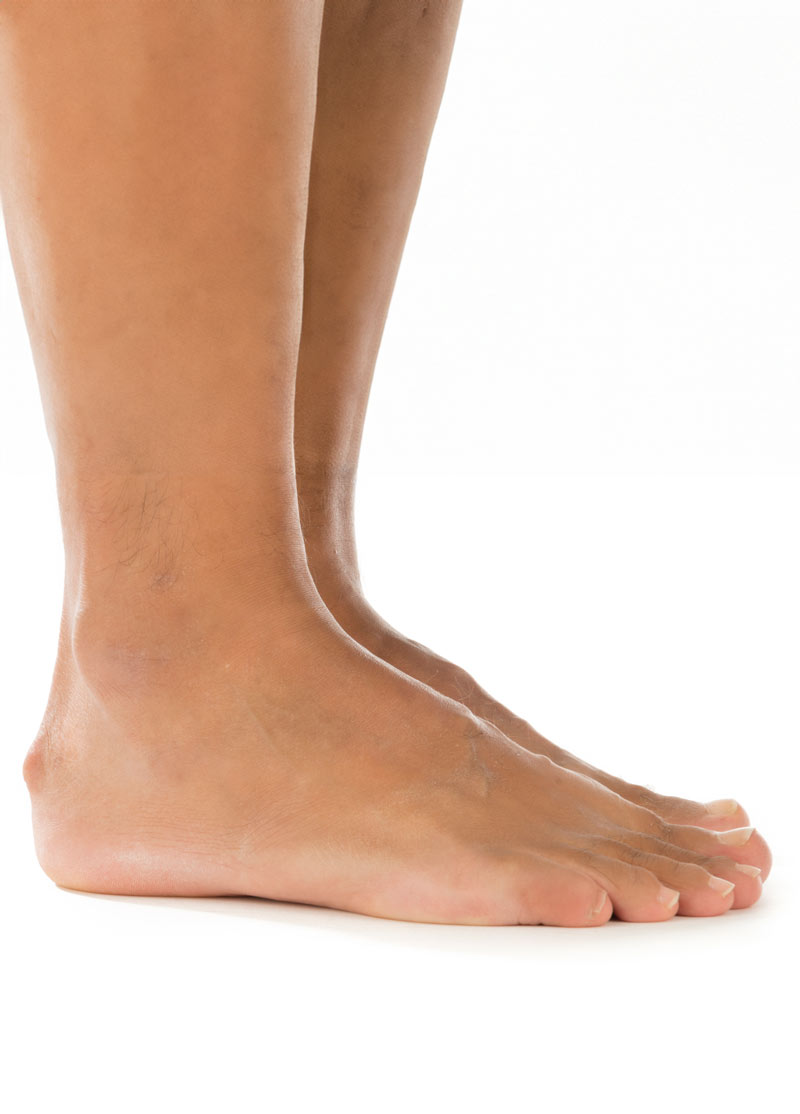 Haglund’s Deformity Diagnosis Muskego Pump Bump Treatment New Berlin